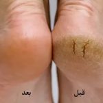 رضایت-از-کرم-ترک-پا